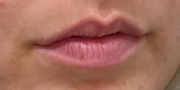 Lip Filler Before & After Gallery - Patient 61325628 - Image 3