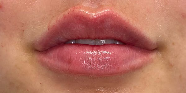 Lip Filler Before & After Gallery - Patient 61325628 - Image 4