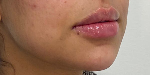 Lip Filler Before & After Gallery - Patient 61325626 - Image 2