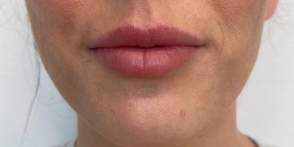 Lip Filler Before & After Gallery - Patient 61325622 - Image 2