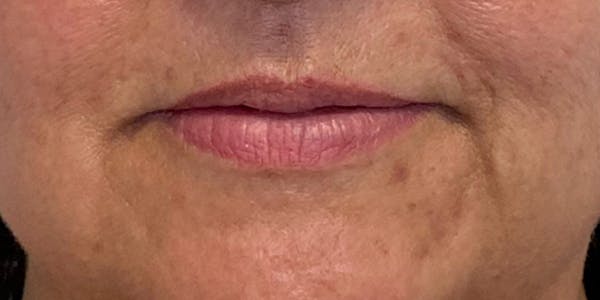 Lip Filler Before & After Gallery - Patient 61325631 - Image 1
