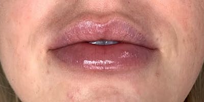 Lip Filler Before & After Gallery - Patient 61325635 - Image 2