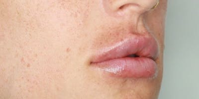 Lip Filler Before & After Gallery - Patient 61325630 - Image 2