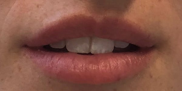 Lip Filler Before & After Gallery - Patient 61325636 - Image 1