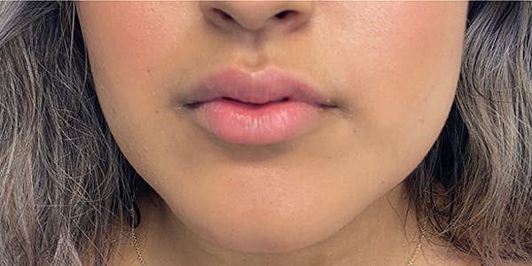 Lip Filler Before & After Gallery - Patient 61325621 - Image 1