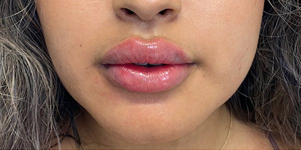 Lip Filler Before & After Gallery - Patient 61325621 - Image 2