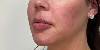 Lip Filler Before & After Gallery - Patient 61325623 - Image 2
