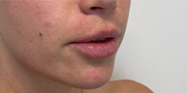 Lip Filler Before & After Gallery - Patient 61325624 - Image 1