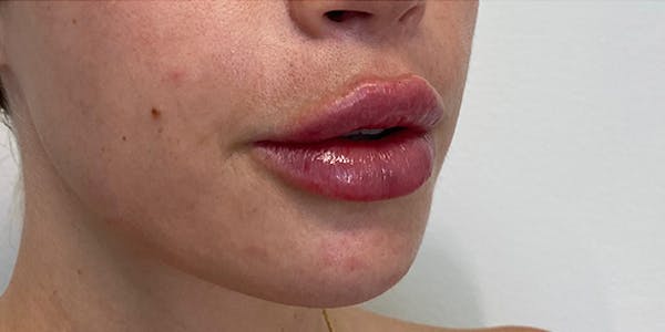 Lip Filler Before & After Gallery - Patient 61325624 - Image 2