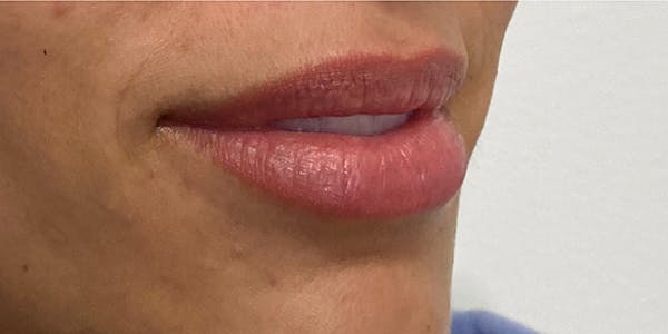 Lip Filler Before & After Gallery - Patient 61325629 - Image 1
