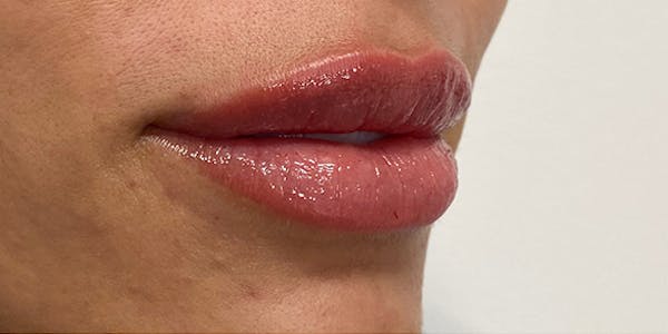 Lip Filler Before & After Gallery - Patient 61325629 - Image 2