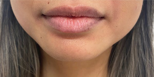 Lip Filler Before & After Gallery - Patient 61325625 - Image 1