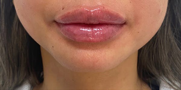 Lip Filler Before & After Gallery - Patient 61325625 - Image 2