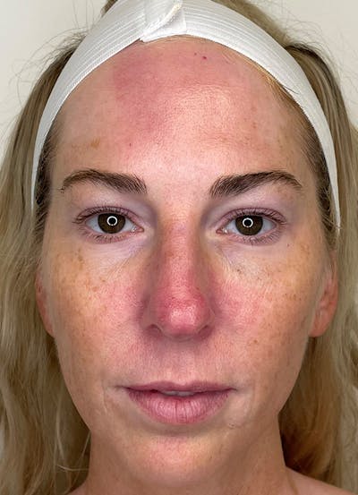 Morpheus8 Before & After Gallery - Patient 68499835 - Image 2