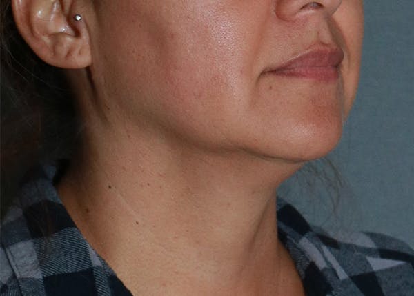 Double Chin (Submental Liposuction) Before & After Gallery - Patient 84619447 - Image 1