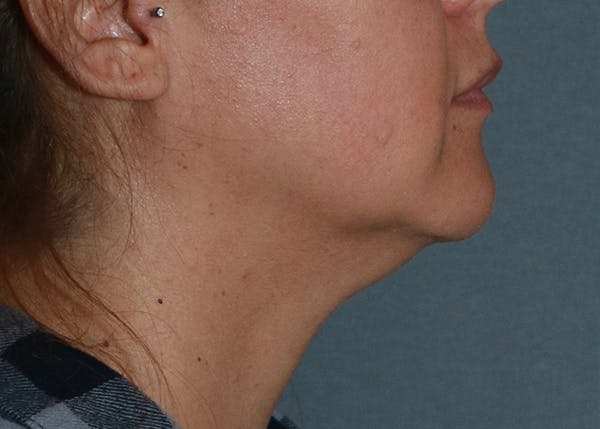 Double Chin (Submental Liposuction) Before & After Gallery - Patient 84619447 - Image 3