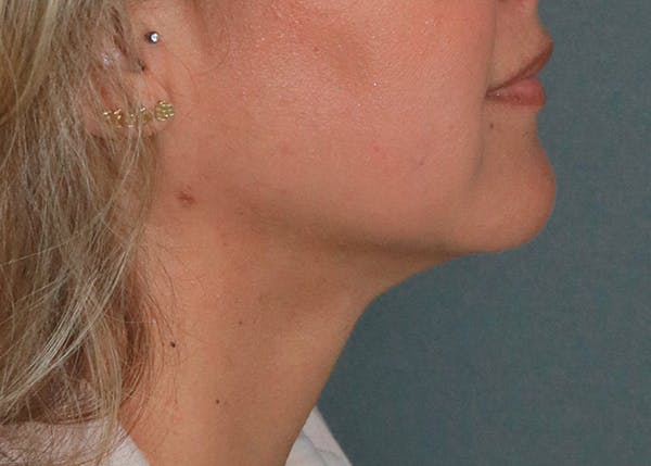 Double Chin (Submental Liposuction) Before & After Gallery - Patient 84619447 - Image 4