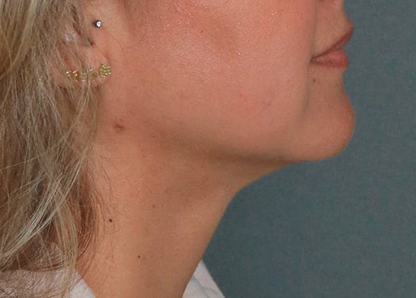 Double Chin (Submental Liposuction) Before & After Gallery - Patient 84619447 - Image 4