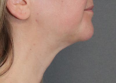 Double Chin (Submental Liposuction) Before & After Gallery - Patient 84619444 - Image 2