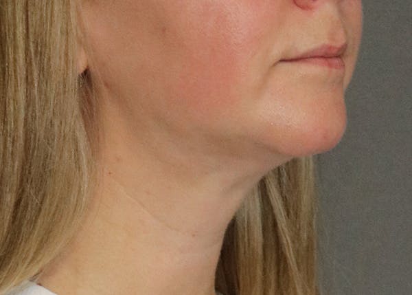 Double Chin (Submental Liposuction) Before & After Gallery - Patient 84619444 - Image 4