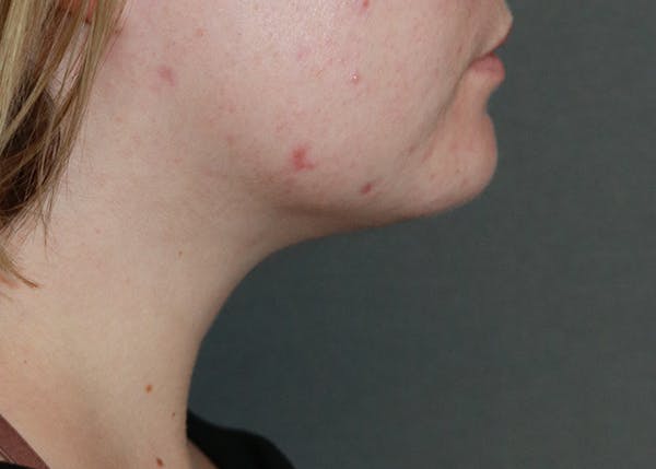 Double Chin (Submental Liposuction) Before & After Gallery - Patient 84619066 - Image 2