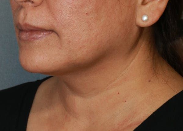 Double Chin (Submental Liposuction) Before & After Gallery - Patient 84618648 - Image 1