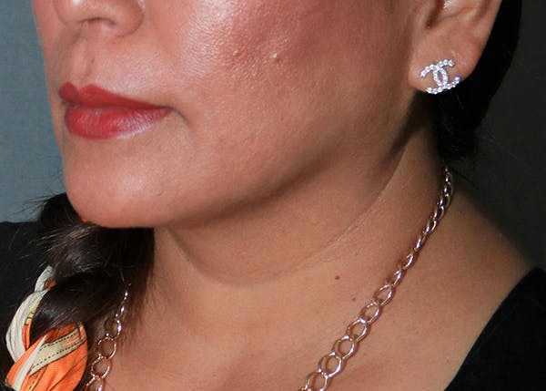 Double Chin (Submental Liposuction) Before & After Gallery - Patient 84618648 - Image 2