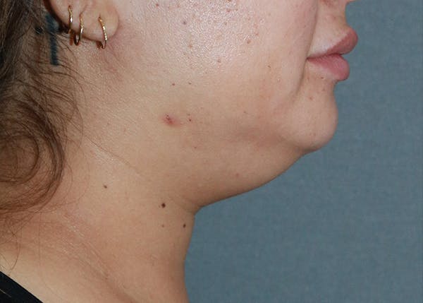 Double Chin (Submental Liposuction) Before & After Gallery - Patient 84618647 - Image 1