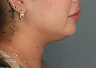 Double Chin (Submental Liposuction) Gallery - Patient 84618647 - Image 2