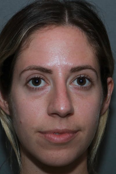 Aesthetic Rhinoplasty Before & After Gallery - Patient 75543195 - Image 1