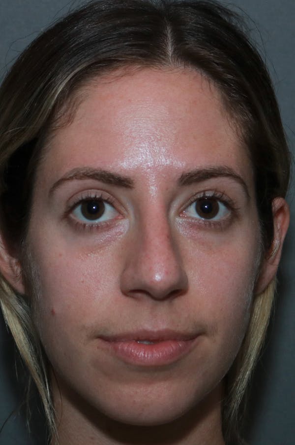 Aesthetic Rhinoplasty Before & After Gallery - Patient 75543195 - Image 1