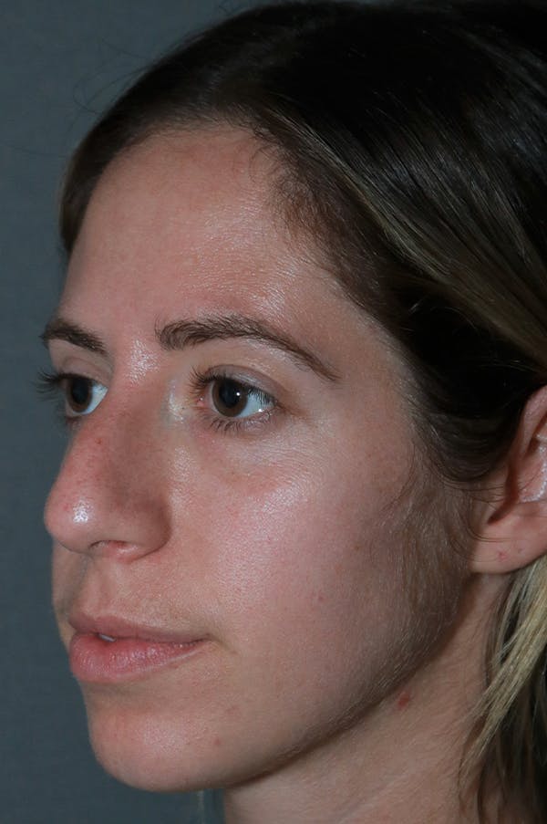 Aesthetic Rhinoplasty Before & After Gallery - Patient 75543195 - Image 3