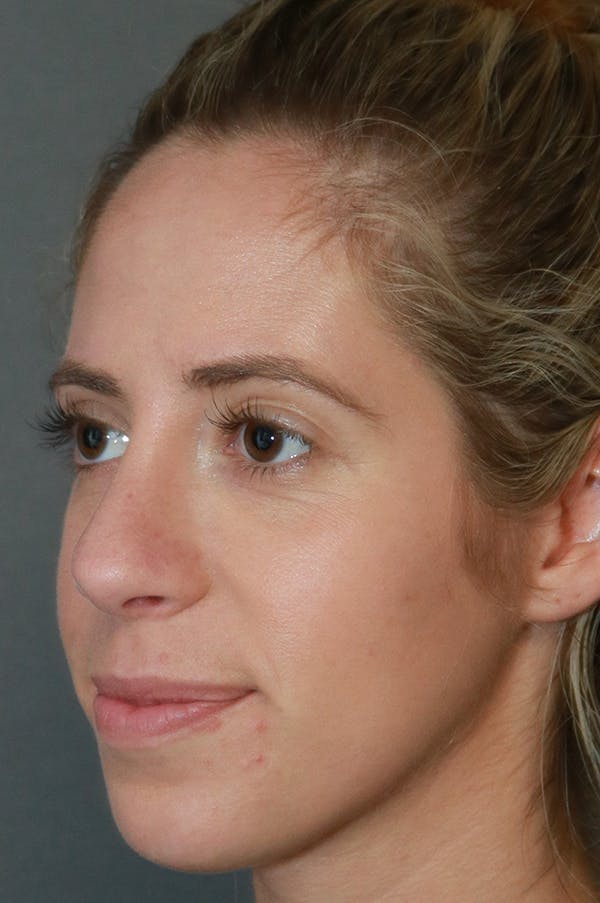 Aesthetic Rhinoplasty Before & After Gallery - Patient 75543195 - Image 4