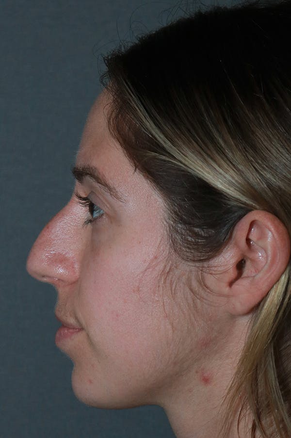 Aesthetic Rhinoplasty Before & After Gallery - Patient 75543195 - Image 5