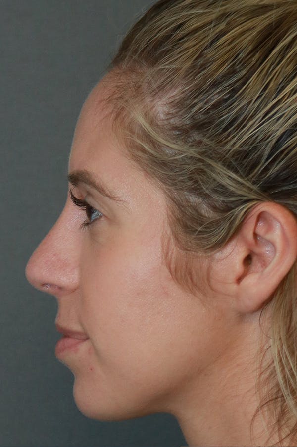 Aesthetic Rhinoplasty Before & After Gallery - Patient 75543195 - Image 6