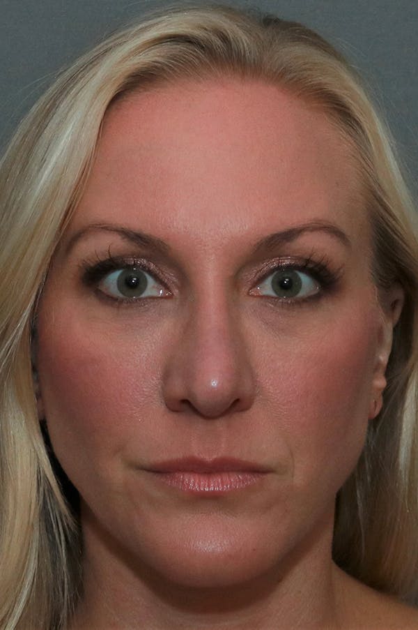 Revision Rhinoplasty Gallery - Patient 75543196 - Image 2