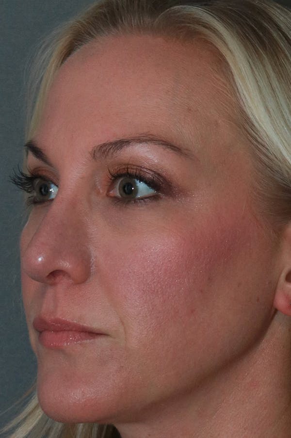 Revision Rhinoplasty Before & After Gallery - Patient 75543196 - Image 4