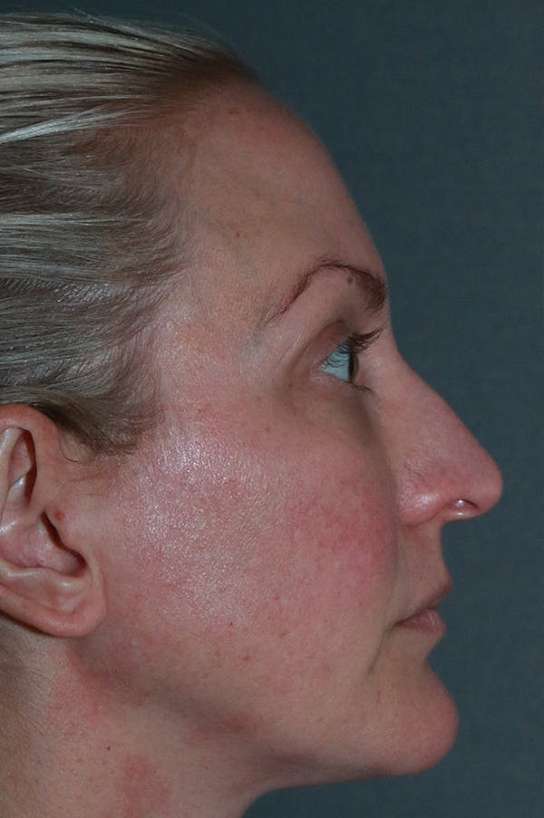 Revision Rhinoplasty Gallery - Patient 75543196 - Image 5