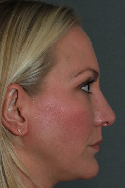 Revision Rhinoplasty Gallery - Patient 75543196 - Image 6