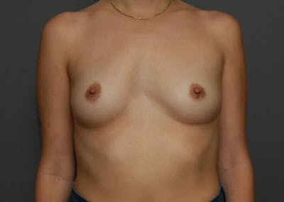 Breast Augmentation Before & After Gallery - Patient 94080413 - Image 1
