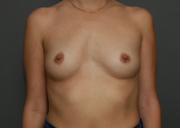 Breast Augmentation Before & After Gallery - Patient 94080413 - Image 1