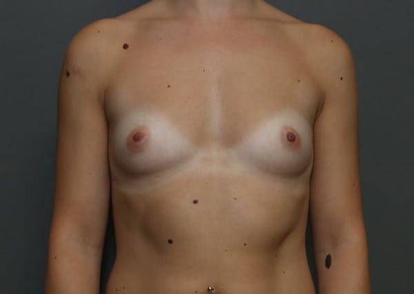 Breast Augmentation Before & After Gallery - Patient 94080424 - Image 1