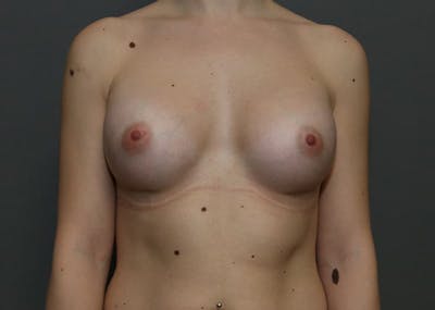 Breast Augmentation Before & After Gallery - Patient 94080424 - Image 2