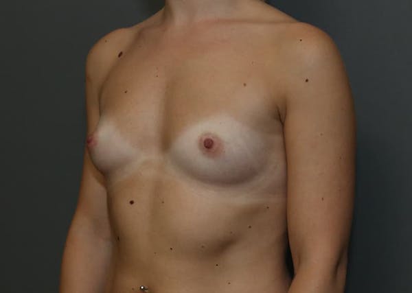 Breast Augmentation Before & After Gallery - Patient 94080424 - Image 3
