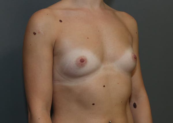 Breast Augmentation Before & After Gallery - Patient 94080424 - Image 7