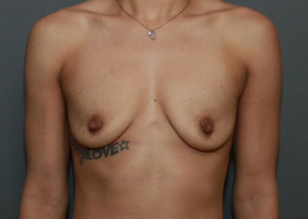Breast Augmentation Before & After Gallery - Patient 94080425 - Image 1