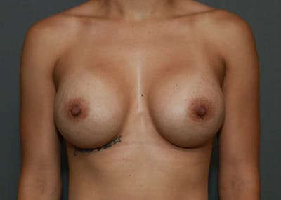 Breast Augmentation Before & After Gallery - Patient 94080425 - Image 2
