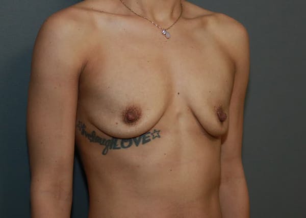 Breast Augmentation Before & After Gallery - Patient 94080425 - Image 3