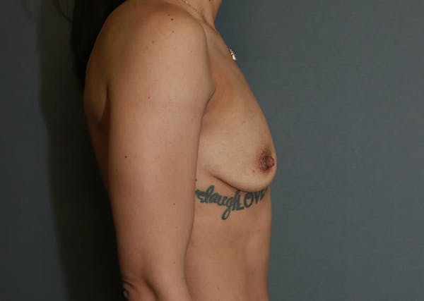 Breast Augmentation Before & After Gallery - Patient 94080425 - Image 5