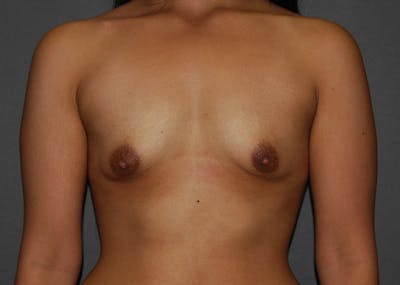 Breast Augmentation Before & After Gallery - Patient 94080427 - Image 1